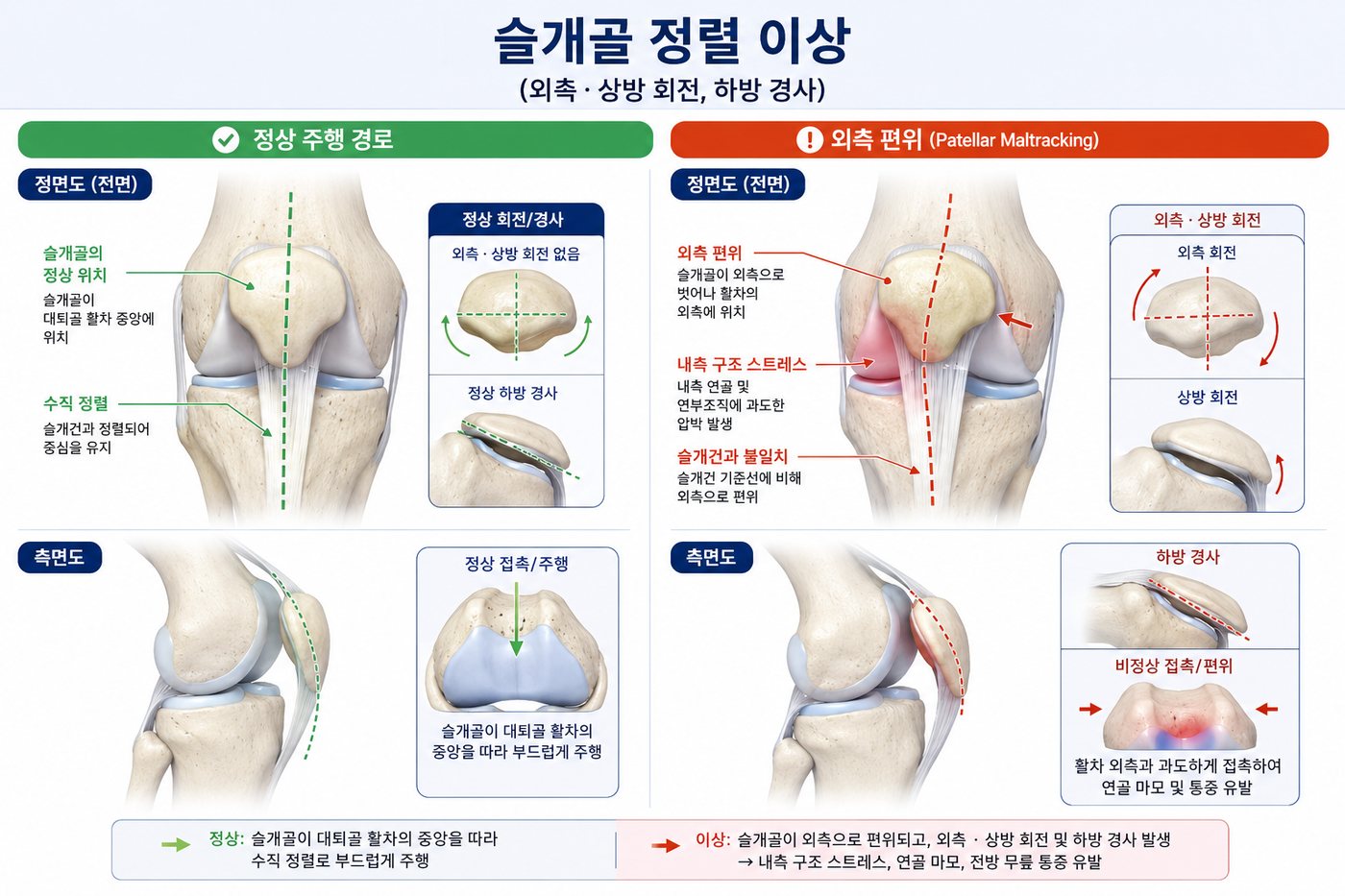 슬개골이 정상 궤도를 따르는 경우와 외측으로 치우친 경우를 비교한 해부 그림